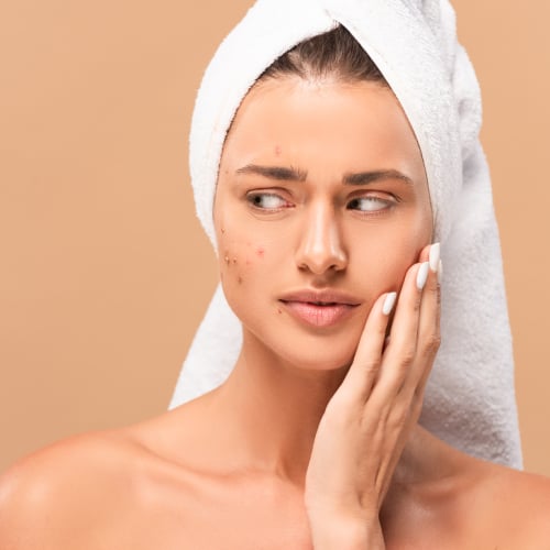 Acne Treatment